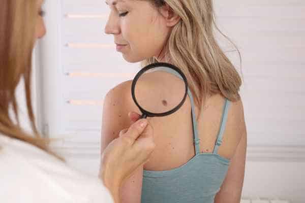 What Are Traditional Skin Lesion Removal Methods Cardiff?