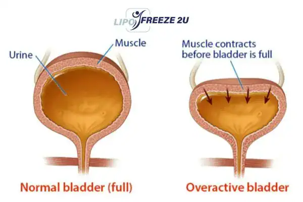 diagram of overactive bladder treatment Cardiff