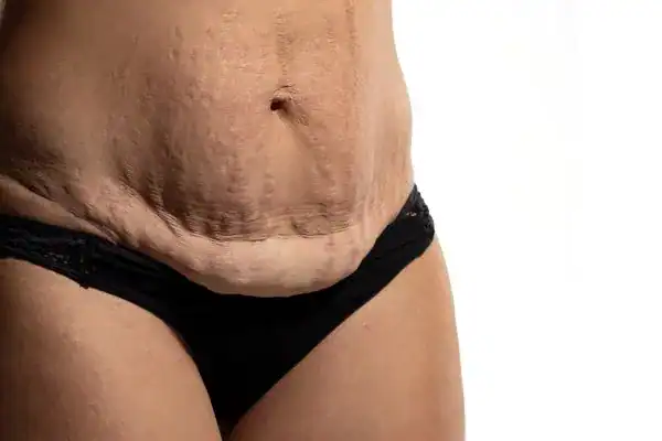 loose skin after weight loss injections Cardiff