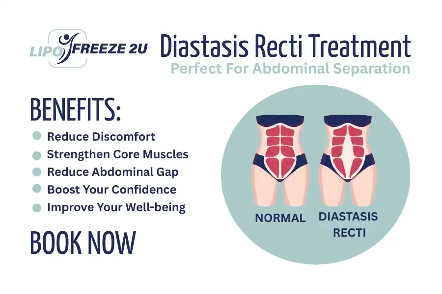 How Long Will It Take to See Improvements in Diastasis Recti Cardiff