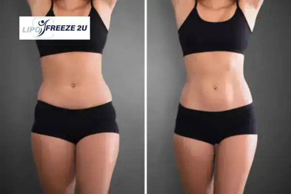 How Can LIPO FREEZE 2U Support Your Post-Pregnancy Body Recovery Cardiff?