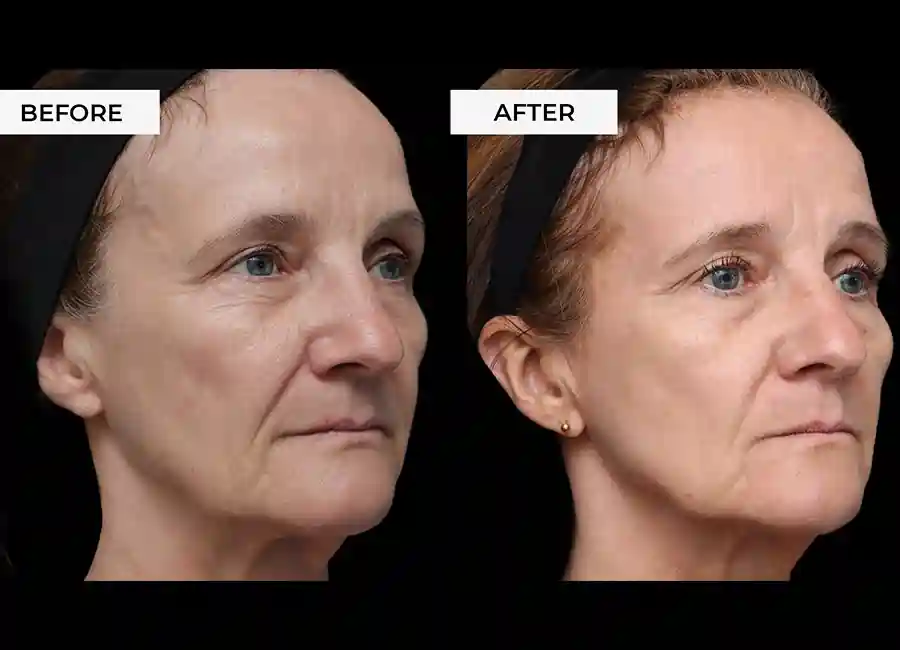 How Many RF Microneedling Sessions Will You Need to See a Difference Cardiff?