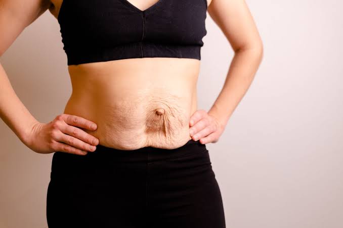 Is Surgery Really the Only Way to Repair Diastasis Recti Cardiff?
