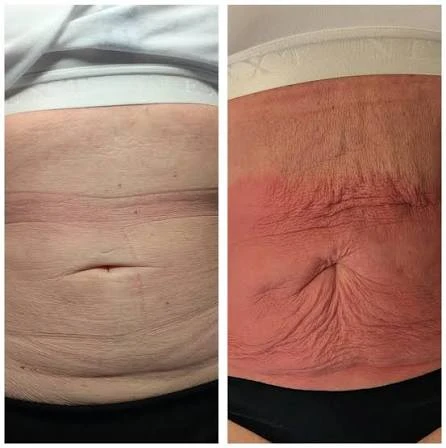 How Does RF Microneedling Improve Crepey, Thin and Uneven Skin Texture Cardiff?