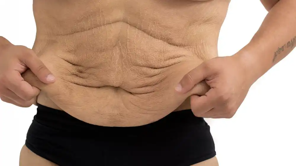Why Does Weight Loss Medication Leave Some People With Loose or Sagging Skin Cardiff?